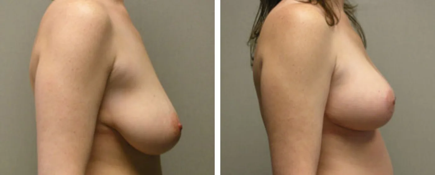 Breast lift c