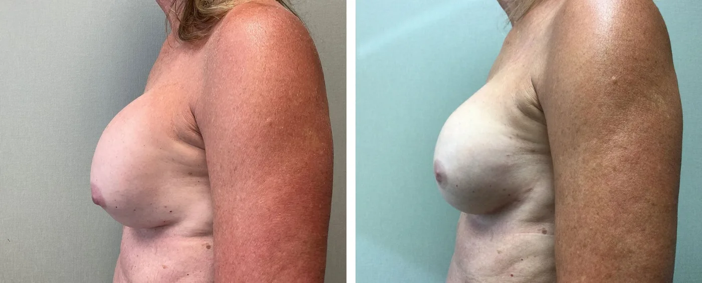 Breast Implant Removal and Replacement in Michigan b