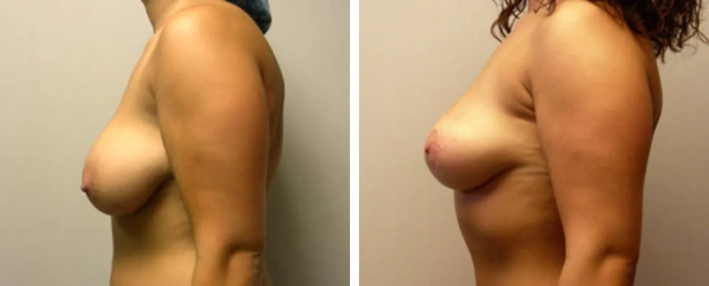 Breast lift c