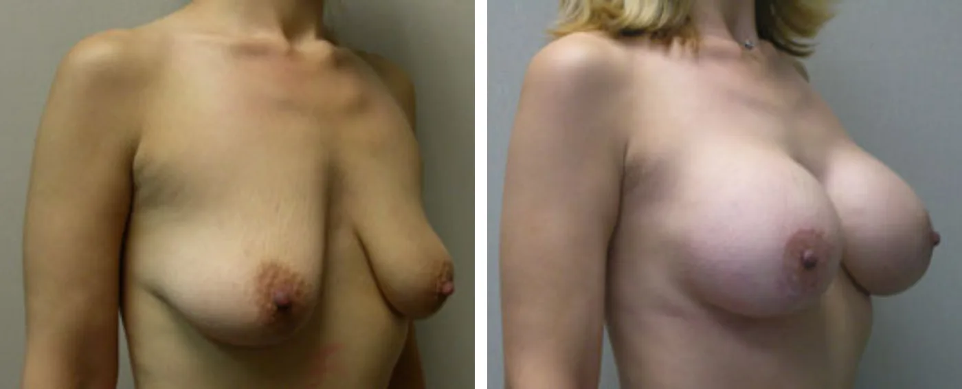 Breast Augmentation with Lollipop Lift b
