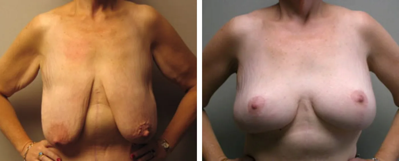 Breast lift a