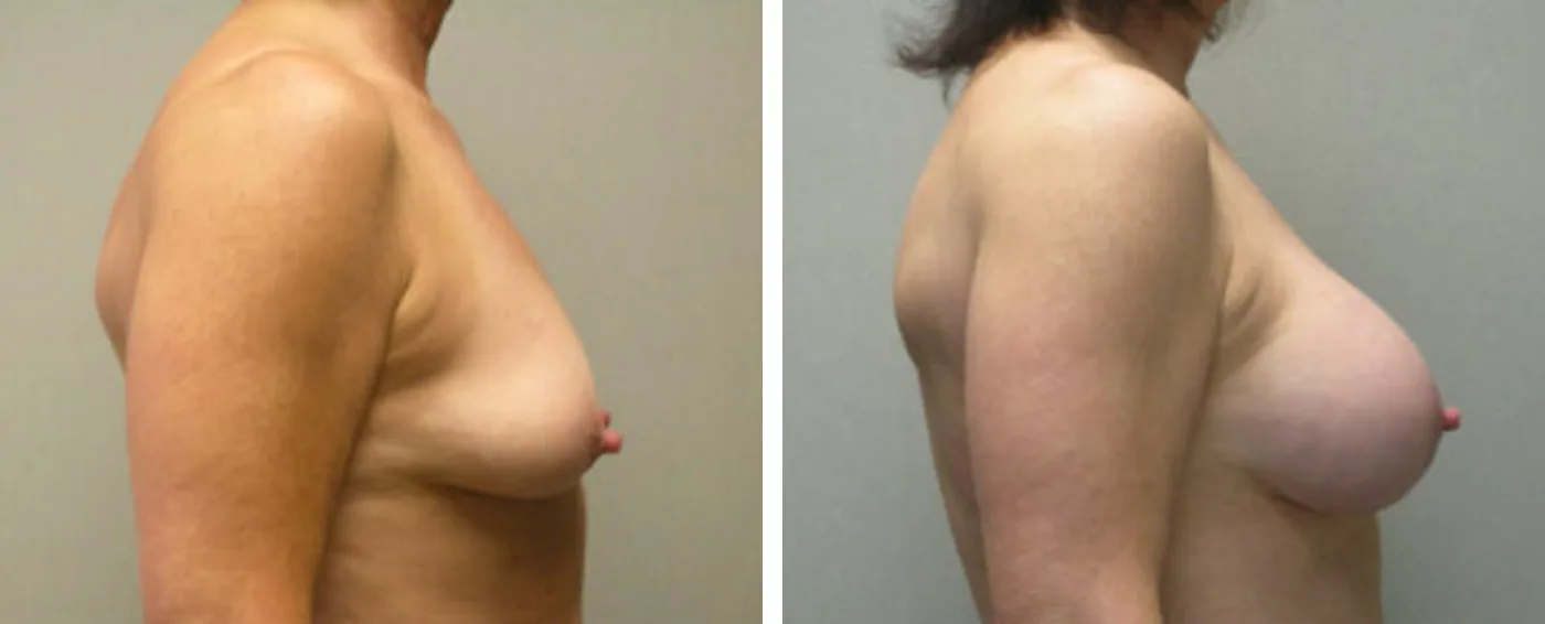 Breast Aug Periareolar lift c