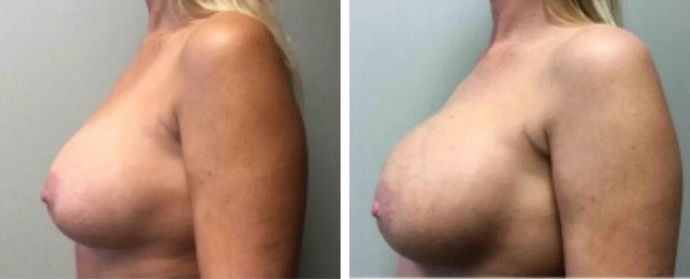 Breast Implant Removal and Replacement in Michigan c
