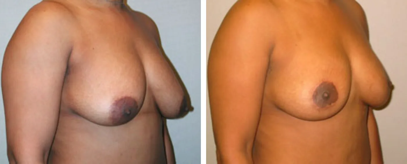 Breast lift b