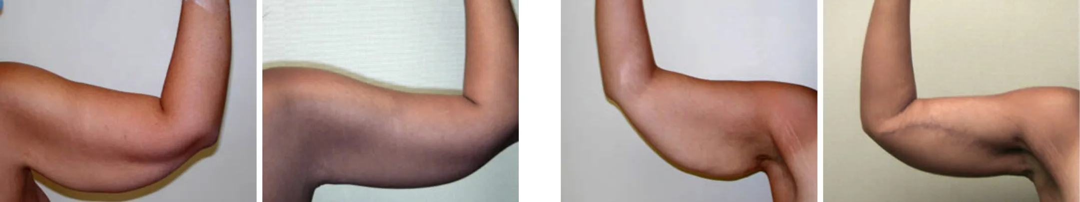 Best Arm Lift In Michgian () Best Arm Lift In Michgian ()