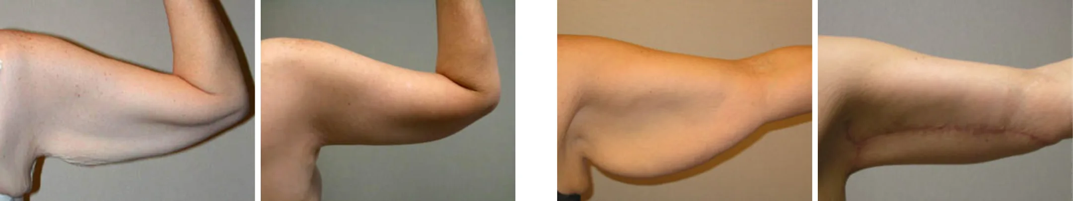 Best Arm Lift In Michgian () Best Arm Lift In Michgian ()