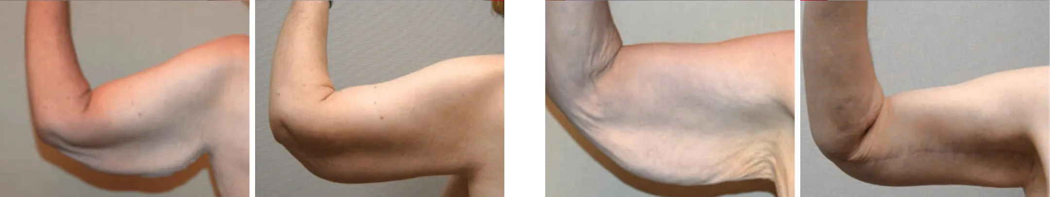 Best Arm Lift In Michgian () Best Arm Lift In Michgian ()