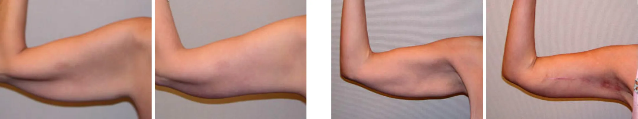 Best Arm Lift In Michgian Best Arm Lift In Michgian