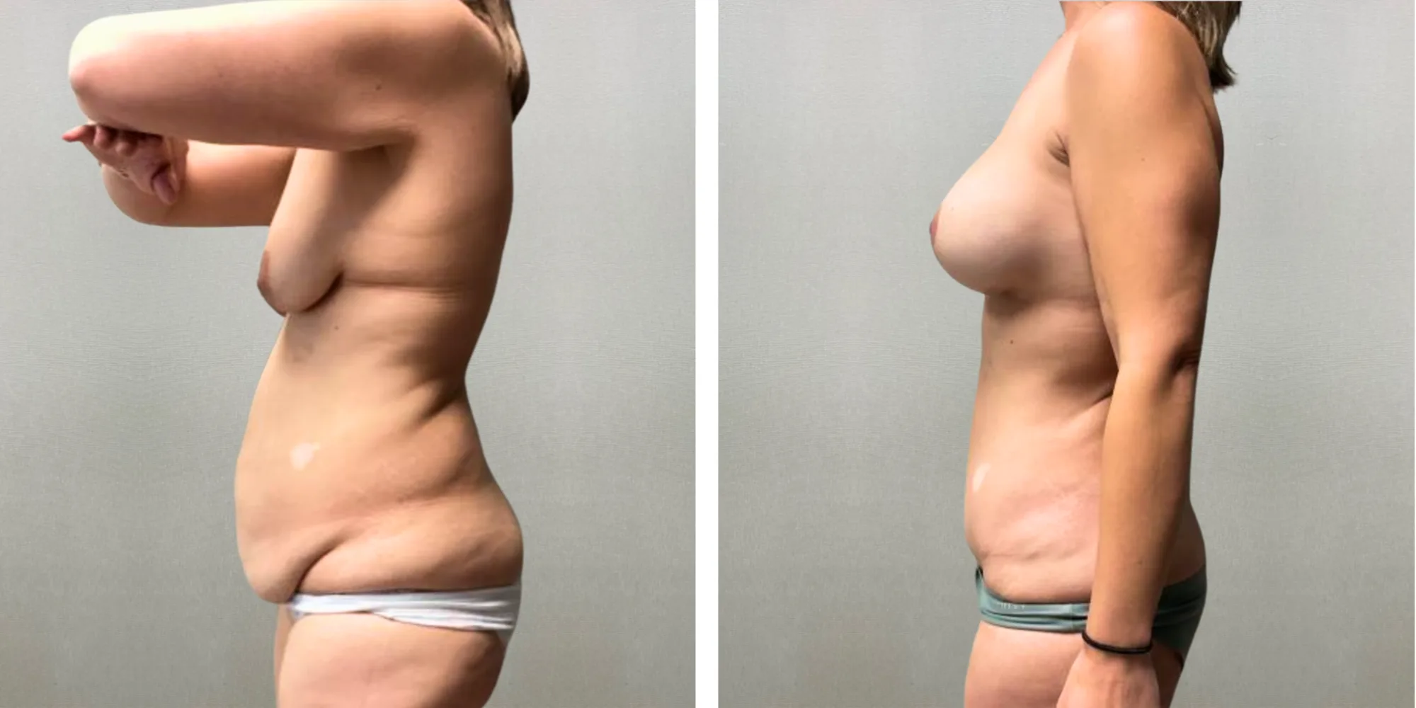 Best Mommy Makeover in Farmigton Hills Michigan ()