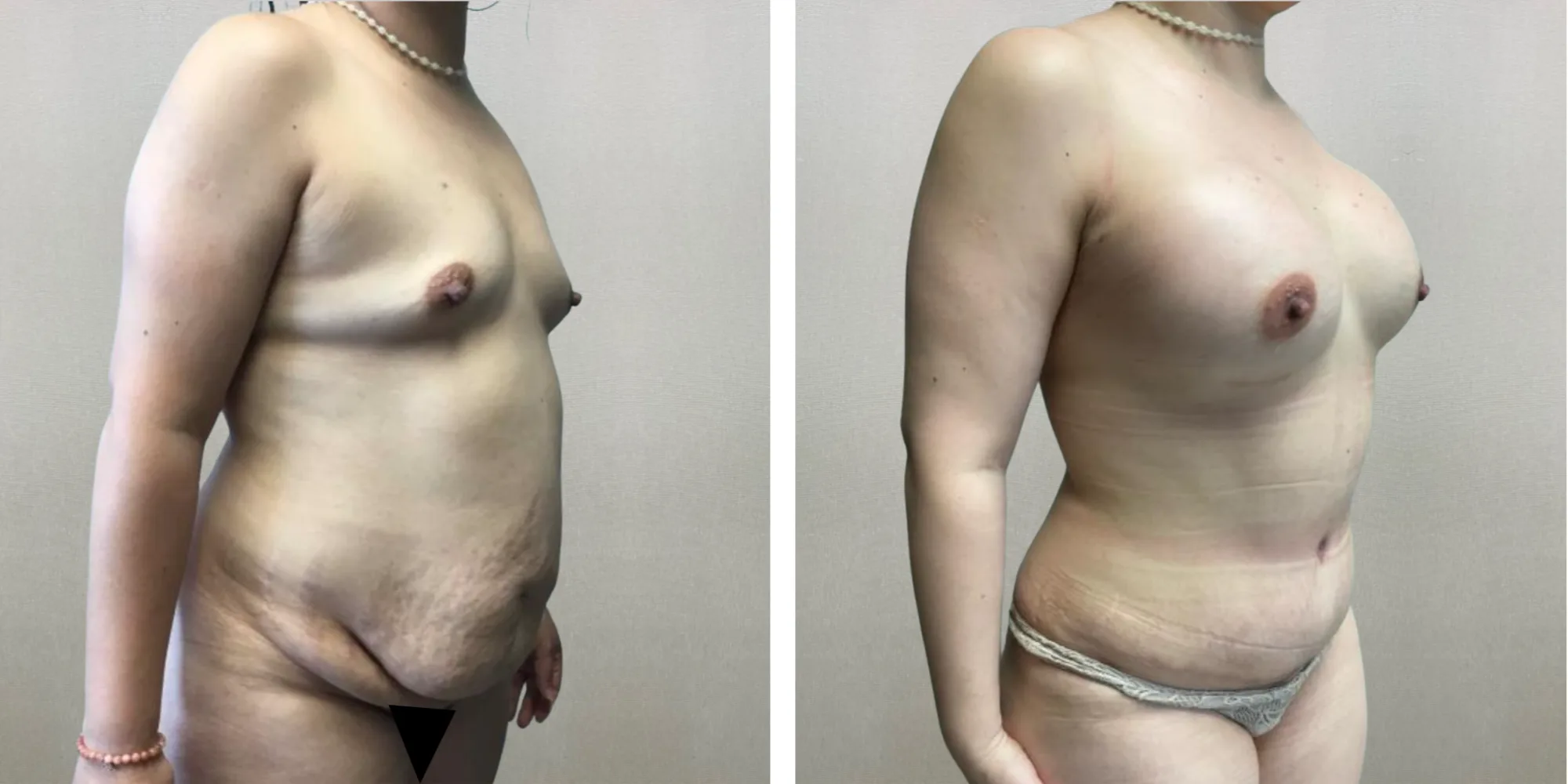 Best Mommy Makeover in Soutfield Michigan ()