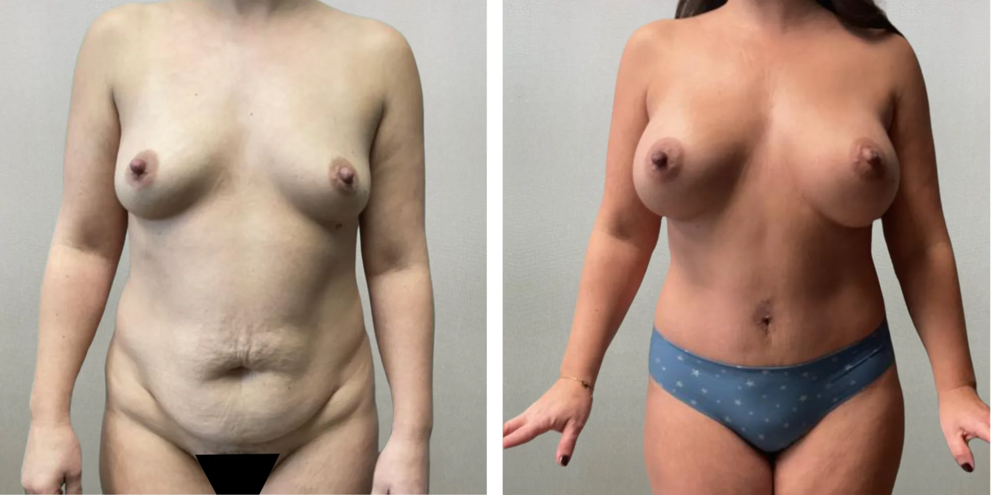 Best Mommy Makeover in Troy Michigan