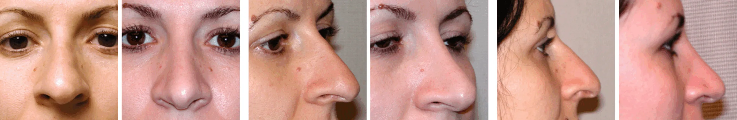 Best Rhinoplasty in Michigan ()