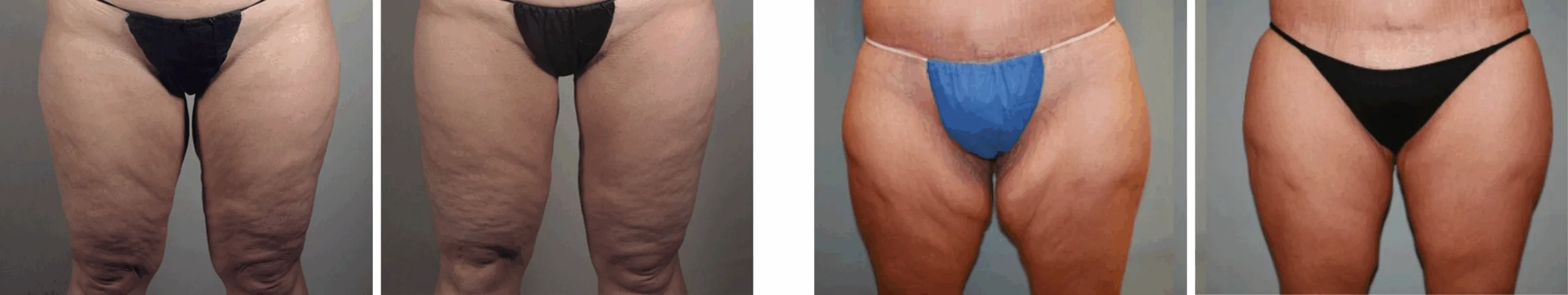 Best Thigh Lift In Michgian () Best Thigh Lift In Michgian ()
