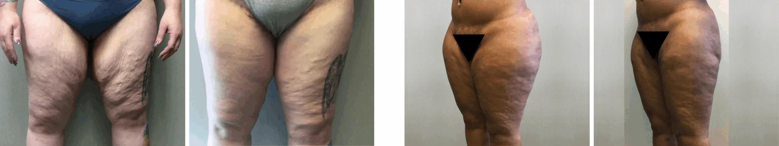 Best Thigh Lift In Michgian () Best Thigh Lift In Michgian ()