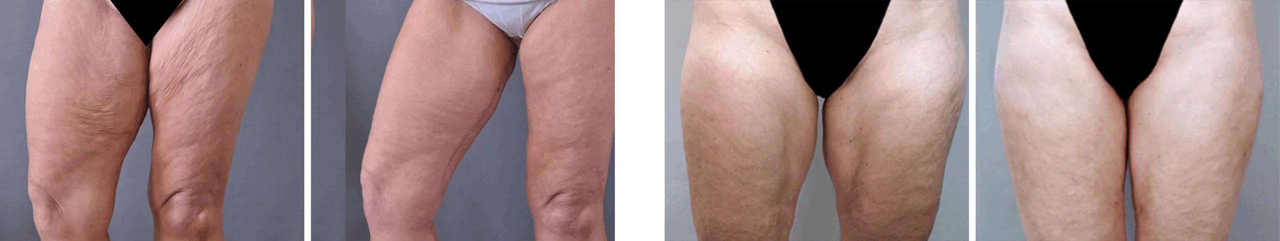 Best Thigh Lift In Michgian Best Thigh Lift In Michgian