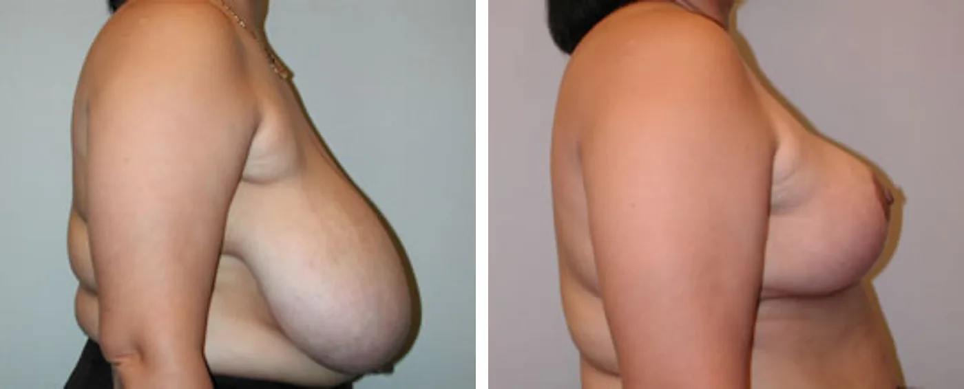 Breast Reduction C