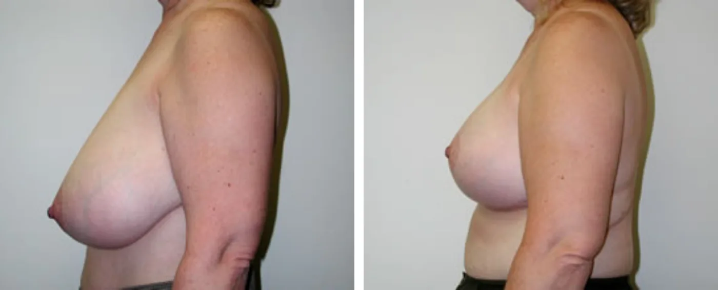 Breast Reduction C