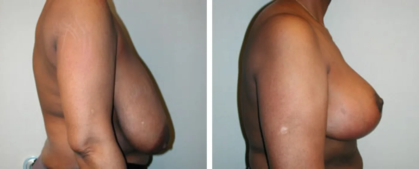 Breast Reduction C