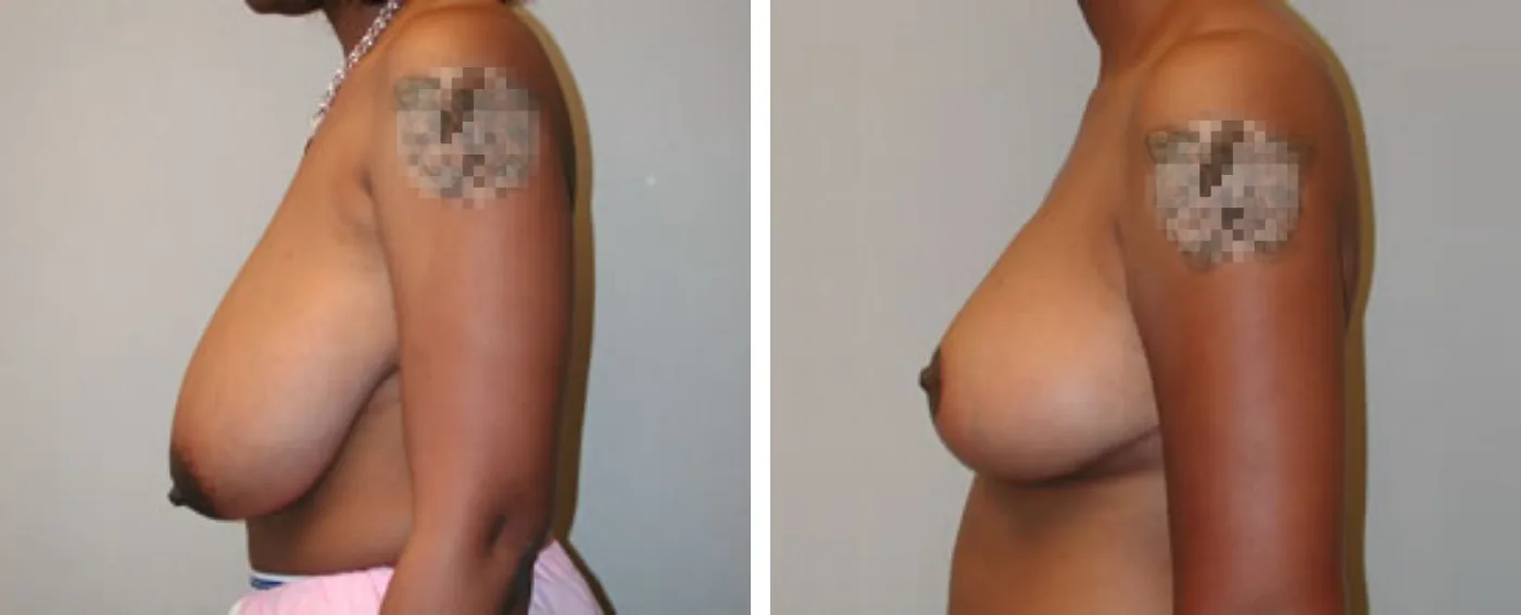 Breast Reduction C