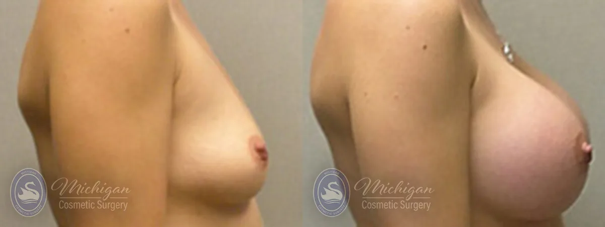 Michigan Cosmetic Surgery Southfield Breast Augmentation P