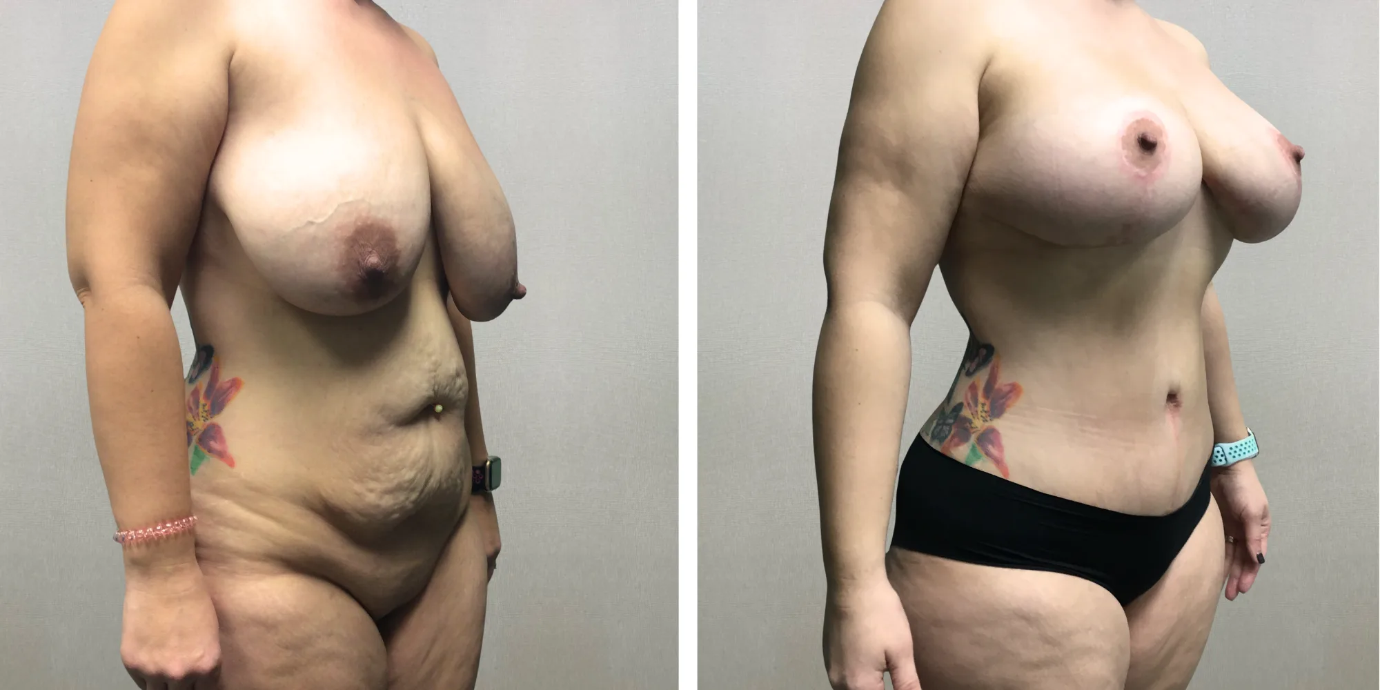 Mommy Makeover with Tummy Tuck and breast reduction